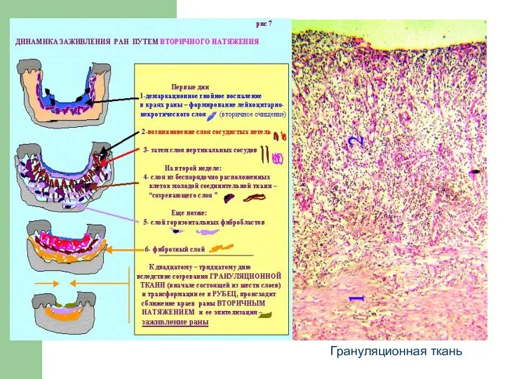 Грануляционная ткань