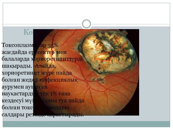 Көру мүшесінің зақымдалуы Токсоплазмалар 35% жағдайда ересектер мен балаларда хориоретиниттерді шақырады. Алайда,