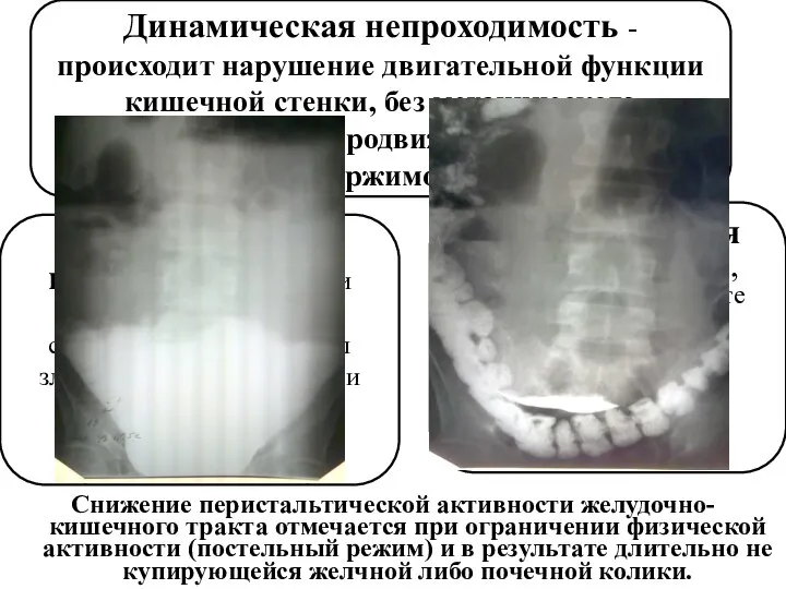 Снижение перистальтической активности желудочно-кишечного тракта отмечается при ограничении физической активности (постельный режим)