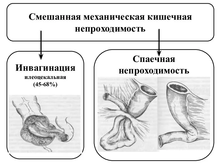 Смешанная механическая кишечная непроходимость Инвагинация илеоцекальная (45-68%) Спаечная непроходимость