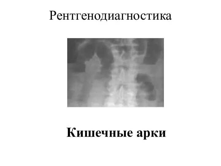 Рентгенодиагностика Кишечные арки