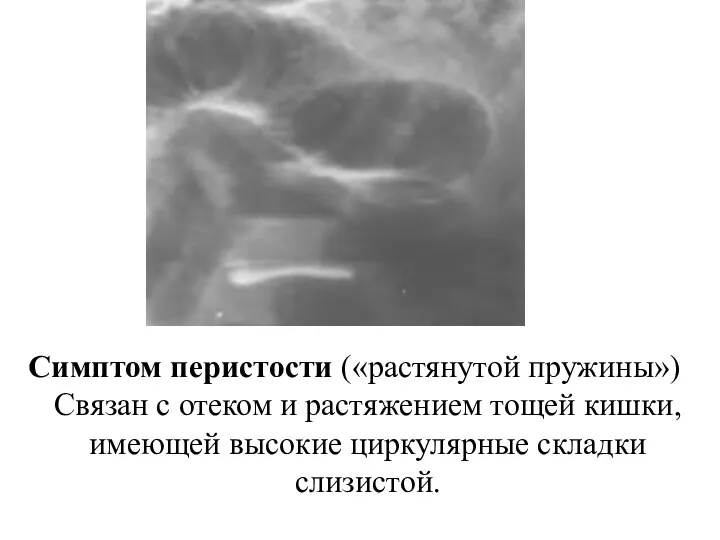 Симптом перистости («растянутой пружины») Связан с отеком и растяжением тощей кишки, имеющей высокие циркулярные складки слизистой.
