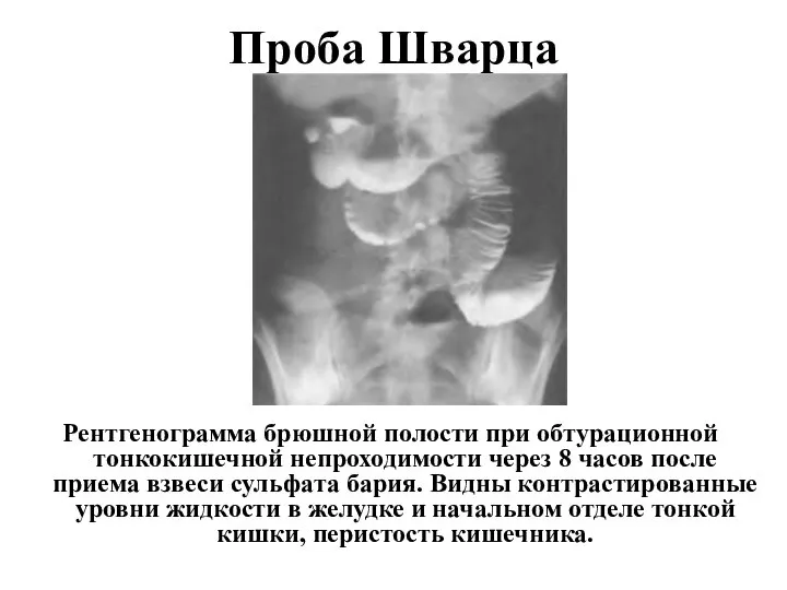 Проба Шварца Рентгенограмма брюшной полости при обтурационной тонкокишечной непроходимости через 8 часов