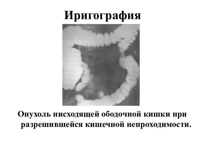 Иригография Опухоль нисходящей ободочной кишки при разрешившейся кишечной непроходимости.
