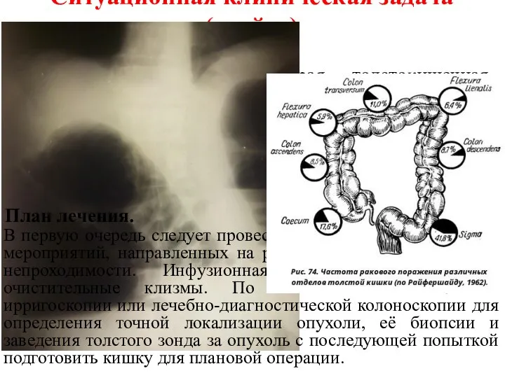 Ситуационная клиническая задача («кейс») ЗНО толстой кишки? Острая толстокишечная непроходимость. Предположительный диагноз.