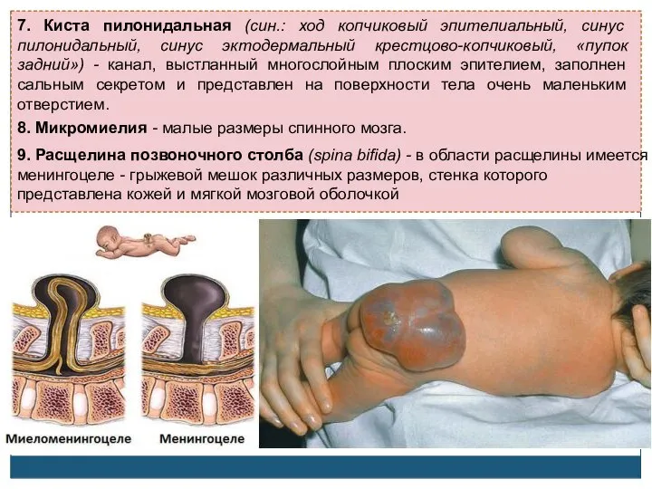 7. Киста пилонидальная (син.: ход копчиковый эпителиальный, синус пилонидальный, синус эктодермальный крестцово-копчиковый,