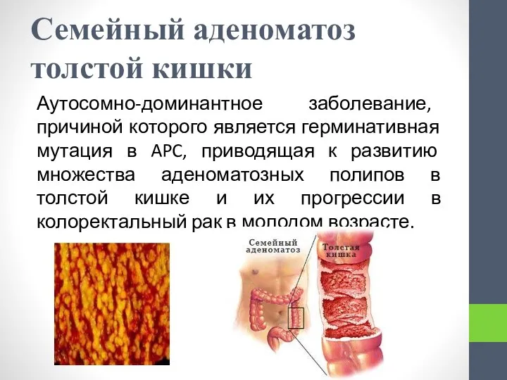 Семейный аденоматоз толстой кишки Аутосомно-доминантное заболевание, причиной которого является герминативная мутация в