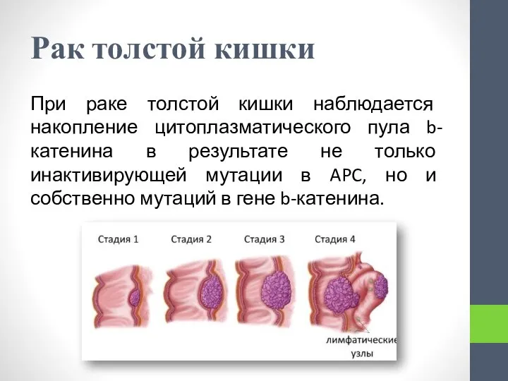 Рак толстой кишки При раке толстой кишки наблюдается накопление цитоплазматического пула b-катенина