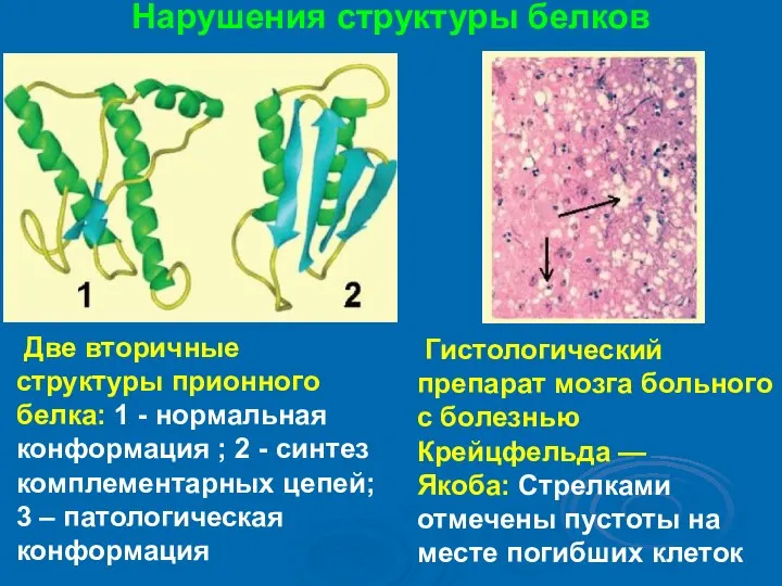 Нарушения структуры белков Две вторичные структуры прионного белка: 1 - нормальная конформация