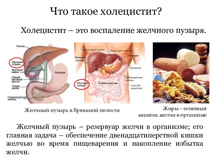 Что такое холецистит? Холецистит – это воспаление желчного пузыря. Желчный пузырь в