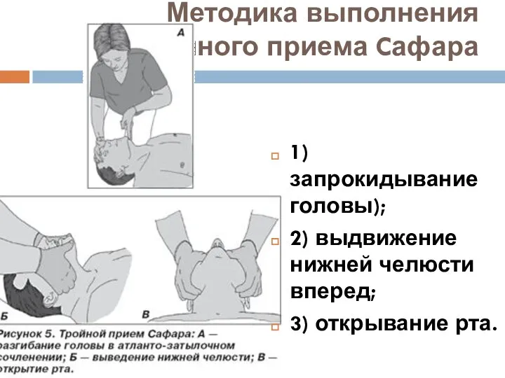 Методика выполнения тройного приема Cафара 1) запрокидывание головы); 2) выдвижение нижней челюсти вперед; 3) открывание рта.