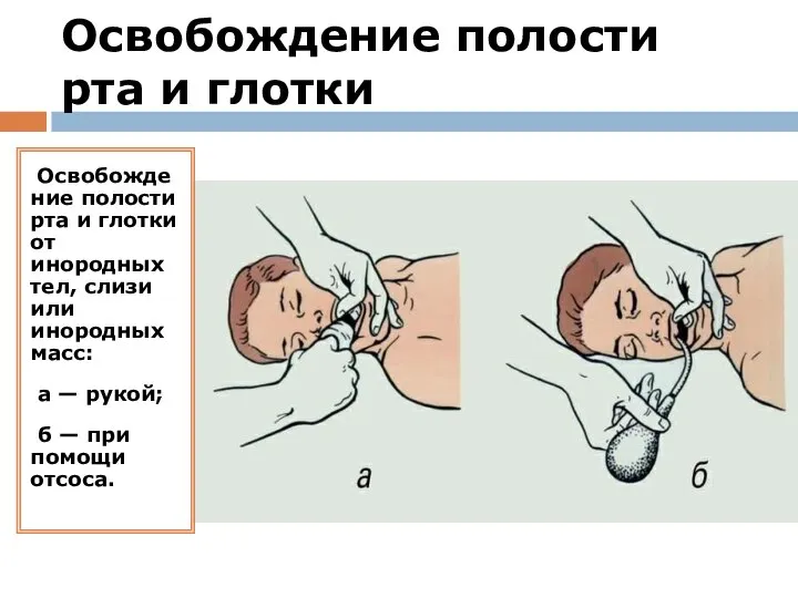 Освобождение полости рта и глотки Освобождение полости рта и глотки от инородных