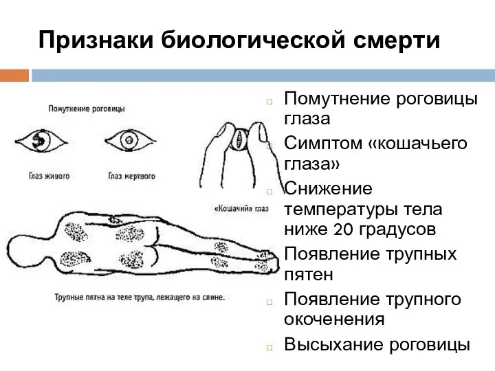 Признаки биологической смерти Помутнение роговицы глаза Симптом «кошачьего глаза» Снижение температуры тела