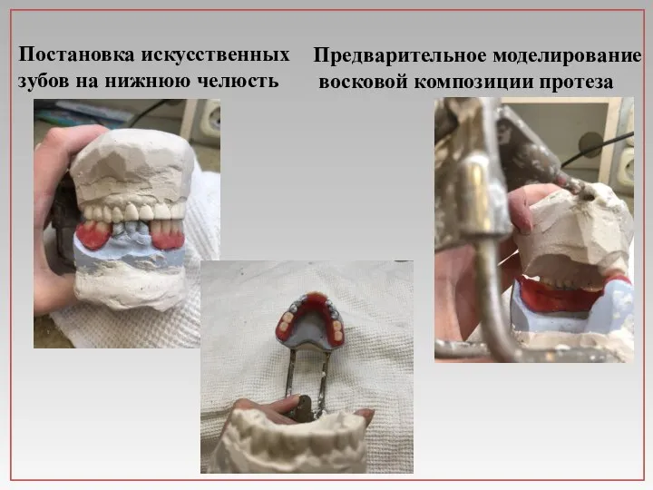Постановка искусственных зубов на нижнюю челюсть Предварительное моделирование восковой композиции протеза