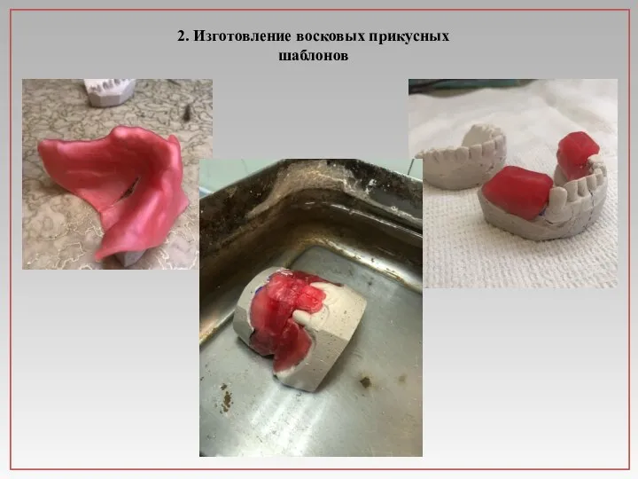 2. Изготовление восковых прикусных шаблонов