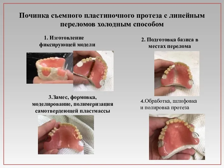 Починка съемного пластиночного протеза с линейным переломов холодным способом 1. Изготовление фиксирующей