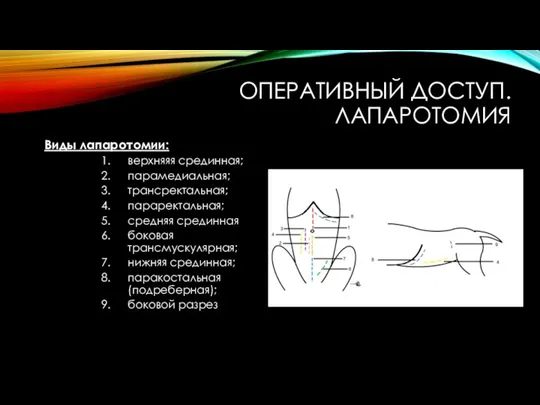 ОПЕРАТИВНЫЙ ДОСТУП. ЛАПАРОТОМИЯ Виды лапаротомии: верхняяя срединная; парамедиальная; трансректальная; параректальная; средняя срединная