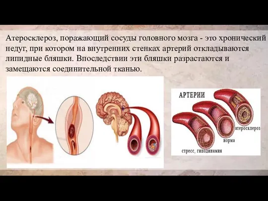 Атеросклероз, поражающий сосуды головного мозга - это хронический недуг, при котором на