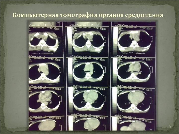 Компьютерная томография органов средостения