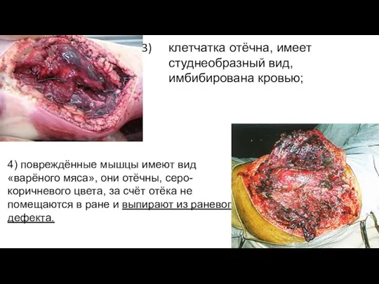 4) повреждённые мышцы имеют вид «варёного мяса», они отёчны, серо-коричневого цвета, за