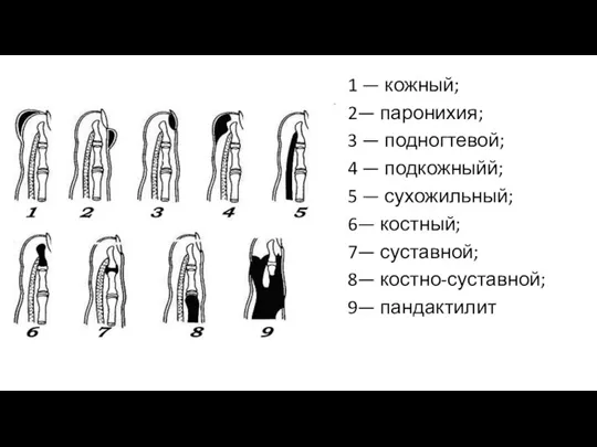 1 — кожный; 2— паронихия; 3 — подногтевой; 4 — подкожныйй; 5