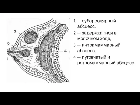 1 — субареолярный абсцесс, 2 — задержка гноя в молочном ходе, 3