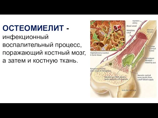 ОСТЕОМИЕЛИТ - инфекционный воспалительный процесс, поражающий костный мозг, а затем и костную ткань.