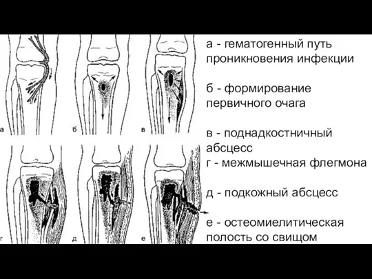 а - гематогенный путь проникновения инфекции б - формирование первичного очага в