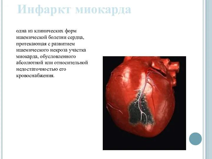 Инфаркт миокарда одна из клинических форм ишемической болезни сердца, протекающая с развитием