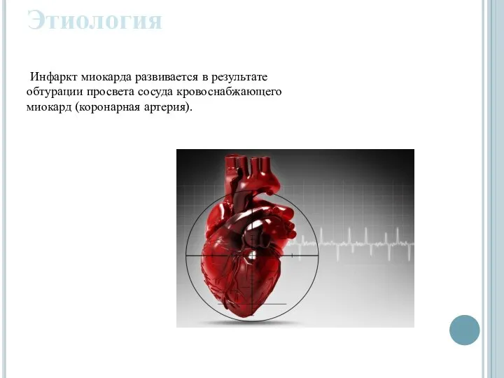 Инфаркт миокарда развивается в результате обтурации просвета сосуда кровоснабжающего миокард (коронарная артерия). Этиология