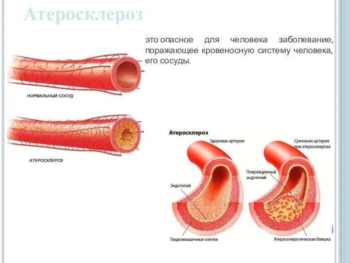 Атеросклероз это опасное для человека заболевание, поражающее кровеносную систему человека, его сосуды.