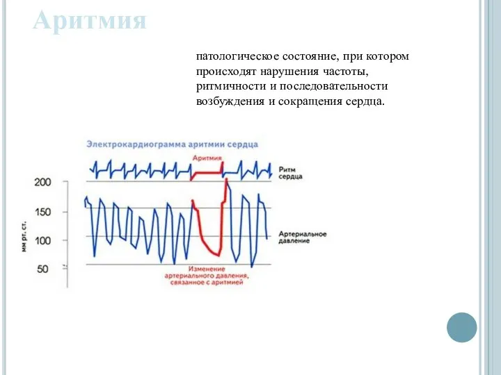 Аритмия патологическое состояние, при котором происходят нарушения частоты, ритмичности и последовательности возбуждения и сокращения сердца.