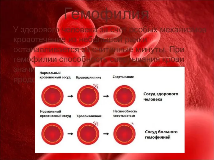 Гемофилия У здорового человека за счет особых механизмов кровотечение из небольшой ранки