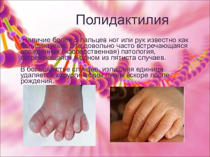 Полидактилия Наличие более 5 пальцев ног или рук известно как полидактилия. Это