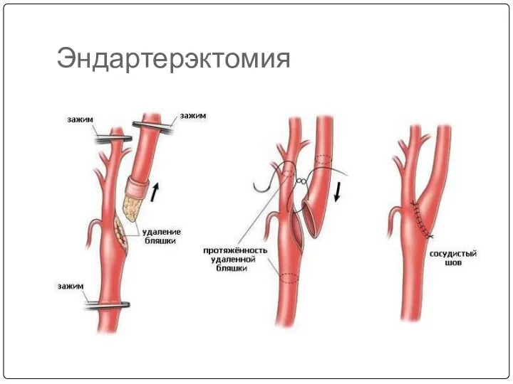 Эндартерэктомия