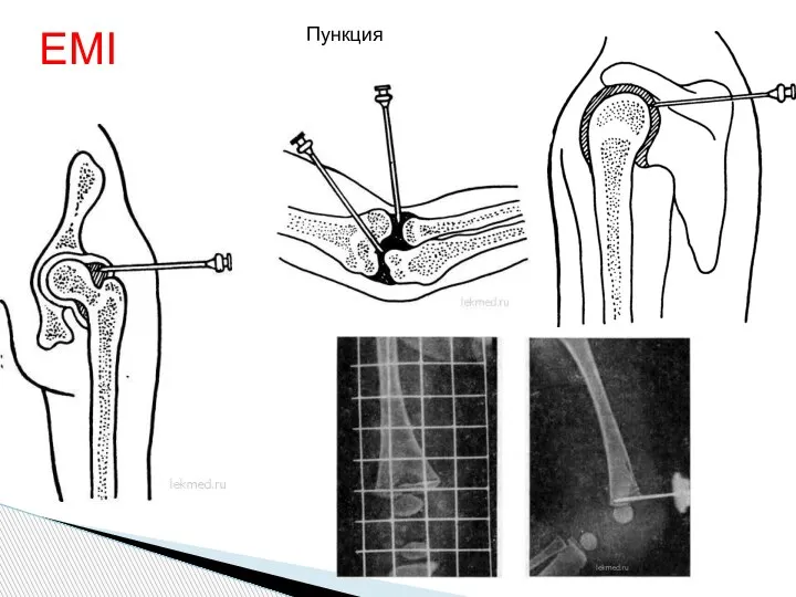 ЕМІ Пункция