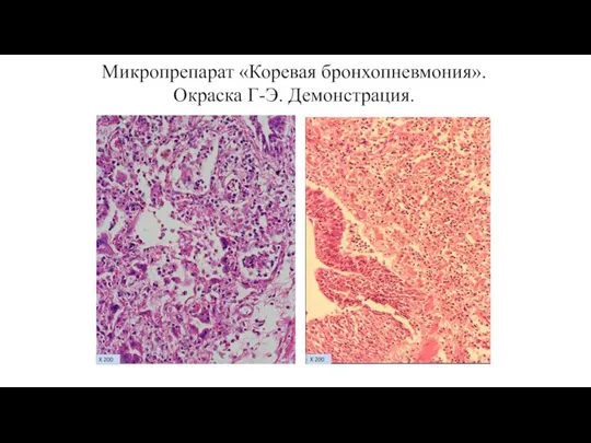 Микропрепарат «Коревая бронхопневмония». Окраска Г-Э. Демонстрация.