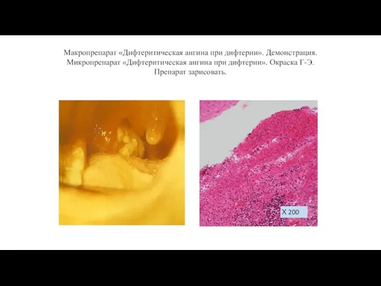 Макропрепарат «Дифтеритическая ангина при дифтерии». Демонстрация. Микропрепарат «Дифтеритическая ангина при дифтерии». Окраска