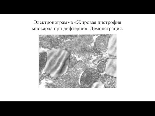 Электронограмма «Жировая дистрофия миокарда при дифтерии». Демонстрация.