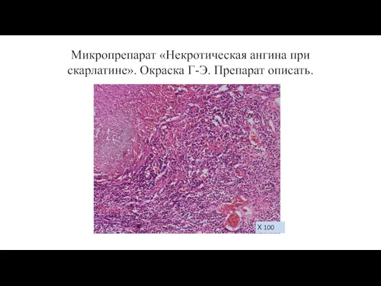 Микропрепарат «Некротическая ангина при скарлатине». Окраска Г-Э. Препарат описать. Х 100