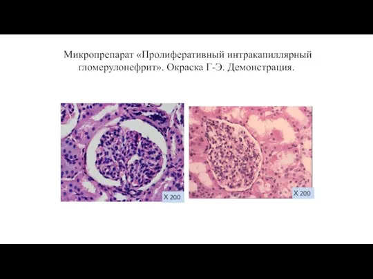 Микропрепарат «Пролиферативный интракапиллярный гломерулонефрит». Окраска Г-Э. Демонстрация. Х 200 Х 200