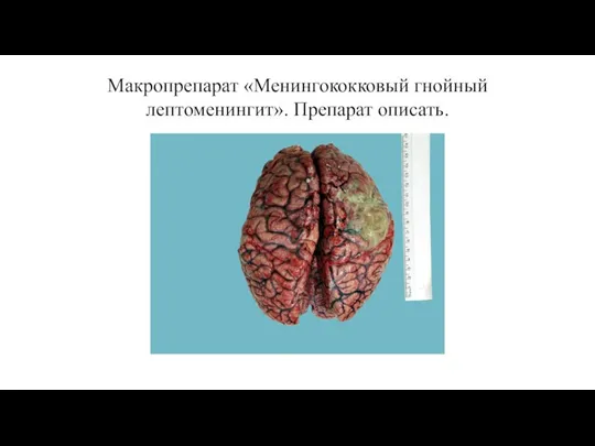 Макропрепарат «Менингококковый гнойный лептоменингит». Препарат описать.