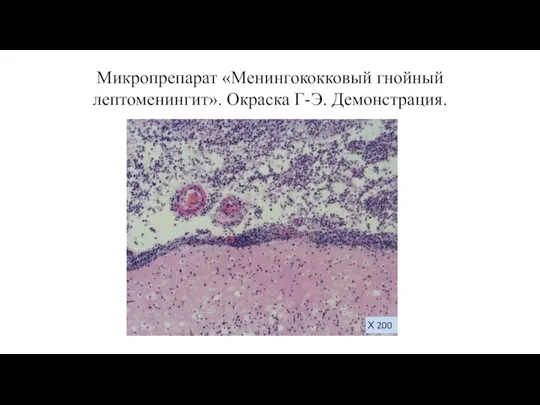 Микропрепарат «Менингококковый гнойный лептоменингит». Окраска Г-Э. Демонстрация. Х 200