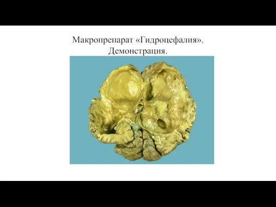 Макропрепарат «Гидроцефалия». Демонстрация.