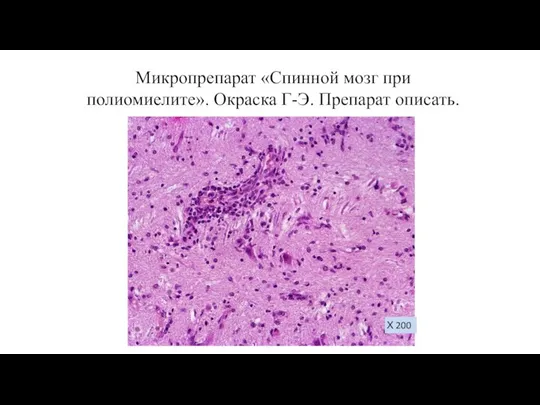 Микропрепарат «Спинной мозг при полиомиелите». Окраска Г-Э. Препарат описать. Х 200