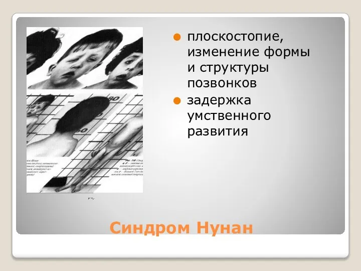 Синдром Нунан плоскостопие, изменение формы и структуры позвонков задержка умственного развития