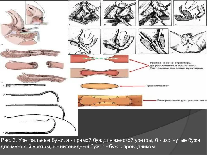 Рис. 2. Уретральные бужи. а - прямой буж для женской уретры, б