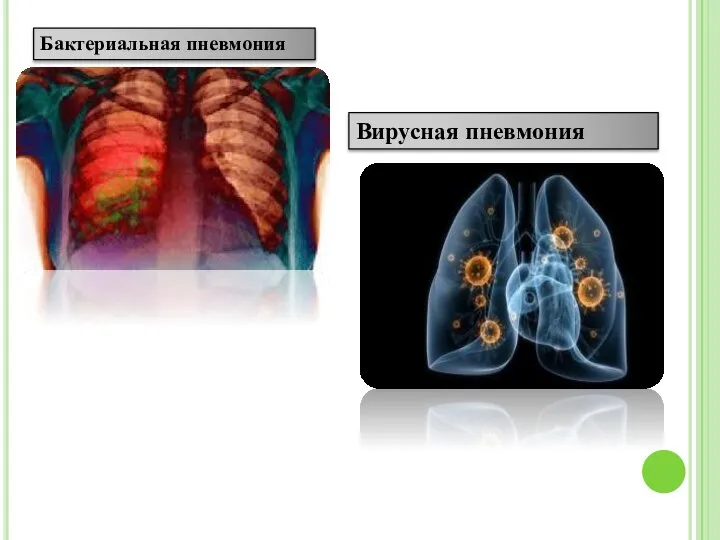 Бактериальная пневмония Вирусная пневмония
