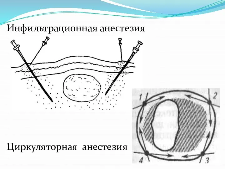 Инфильтрационная анестезия Циркуляторная анестезия