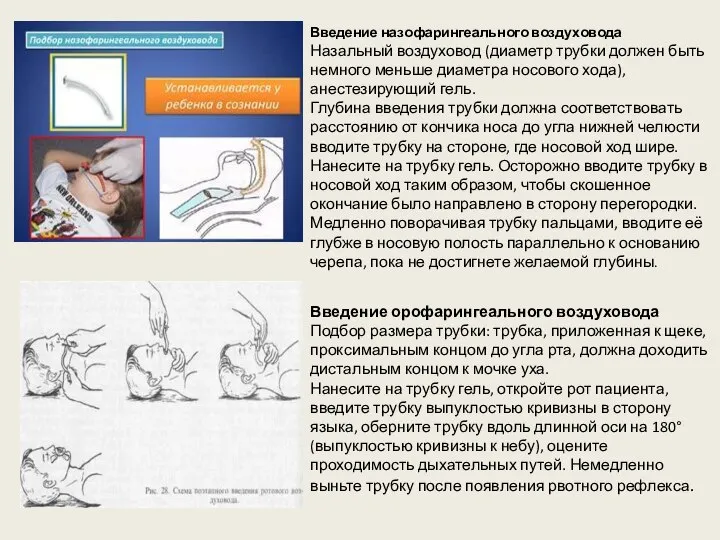 Введение назофарингеального воздуховода Назальный воздуховод (диаметр трубки должен быть немного меньше диаметра